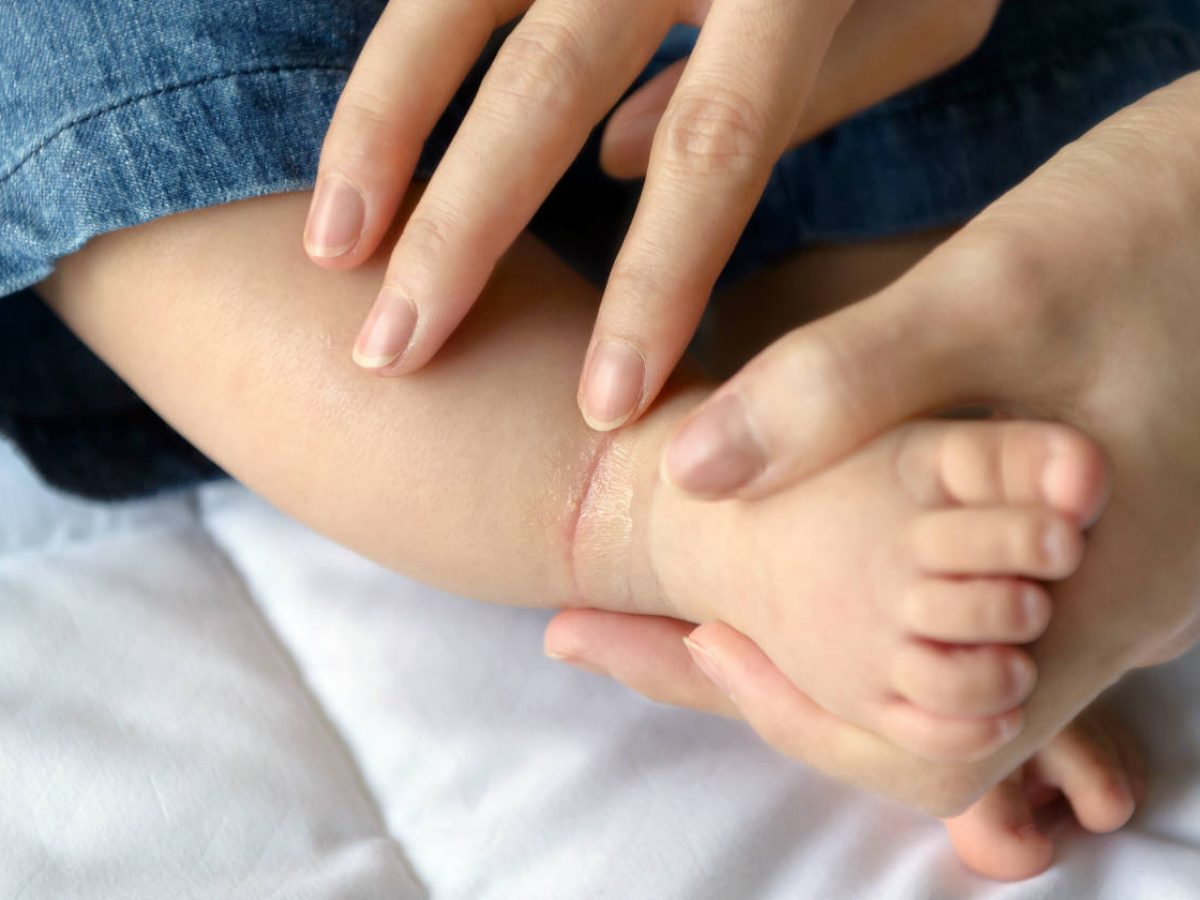 Types Of Eczema Your Complete Guide