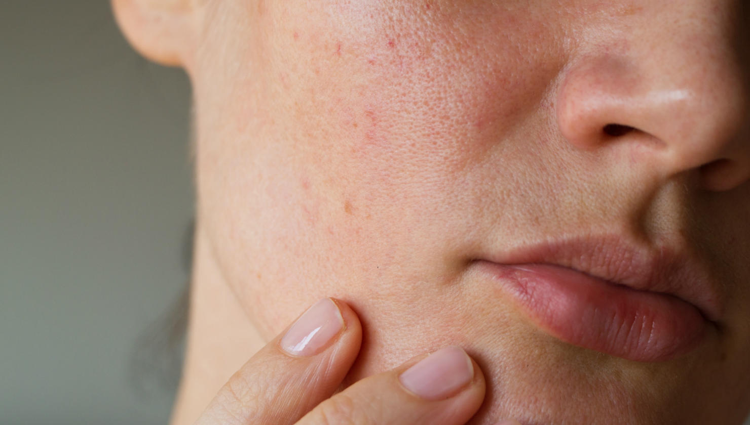 large pores on woman